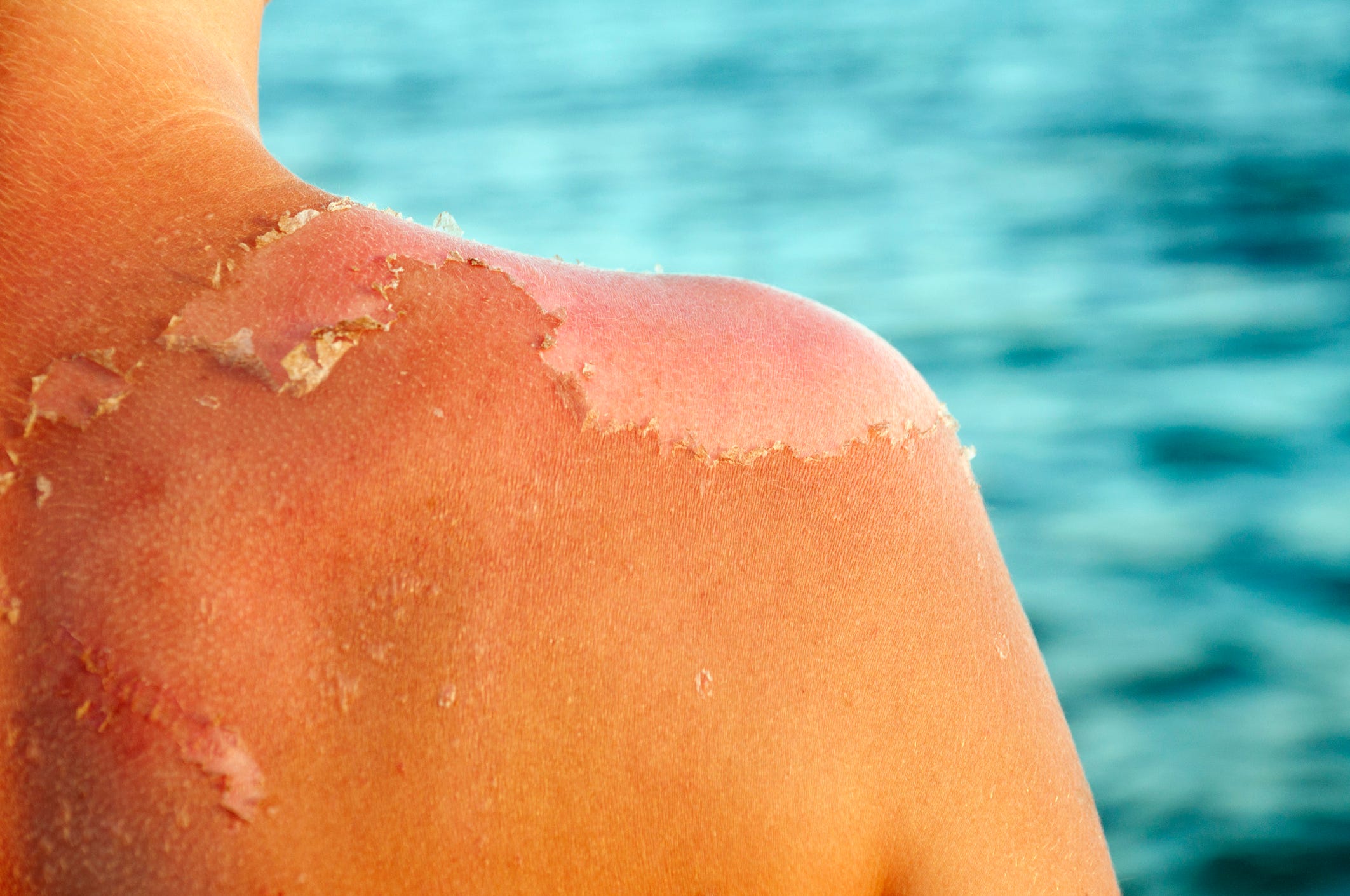 how to stop peeling skin how to stop peeling skin